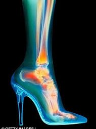 Mang giày cao gót cả ngày, mỗi ngày, có thể gây ra tình trạng viêm ở các ngón chân bị chèn ép, lòng bàn chân và gót chân bị cọ xát.
