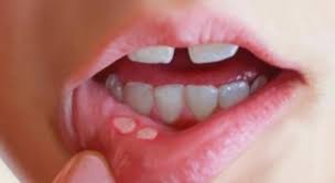 Lở miệng thường xuất hiện ở phần khu vực xung quanh môi và miệng. (Ảnh minh họa: Internet) 