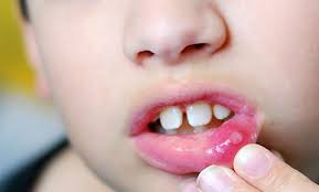Phần lớn các bệnh liên quan tới bệnh lở miệng đều có chung thủ phạm là HSV-1. (Ảnh minh họa: Internet)
